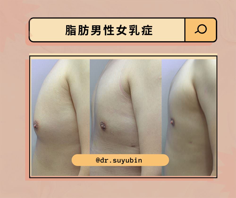 男性女乳症怎麼檢測?手術方式有哪些?術後要怎麼照顧呢? - 第3張圖