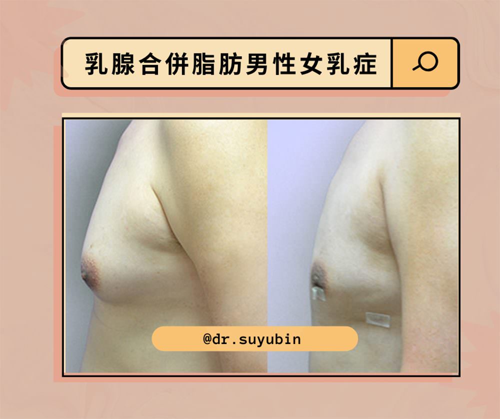 男性女乳症怎麼檢測?手術方式有哪些?術後要怎麼照顧呢? - 第4張圖