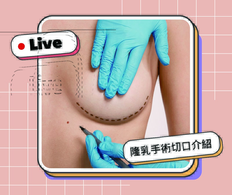隆乳必5大成功要素!手術方式、切口、擺放位置、術後照護通通告訴你! - 第6張圖