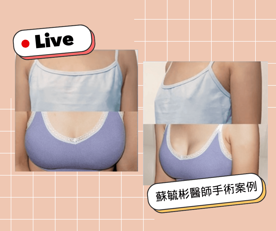不同胸型的隆乳術式解析 下垂外擴大小奶產後萎縮都有解 - 第16張圖