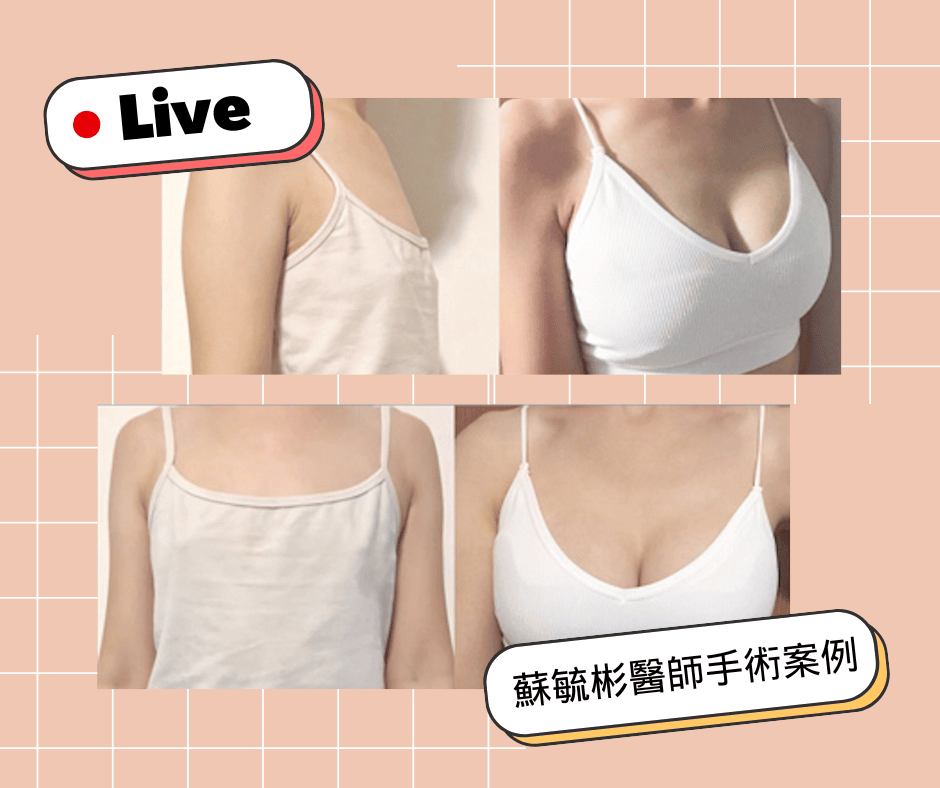 不同胸型的隆乳術式解析 下垂外擴大小奶產後萎縮都有解 - 第12張圖