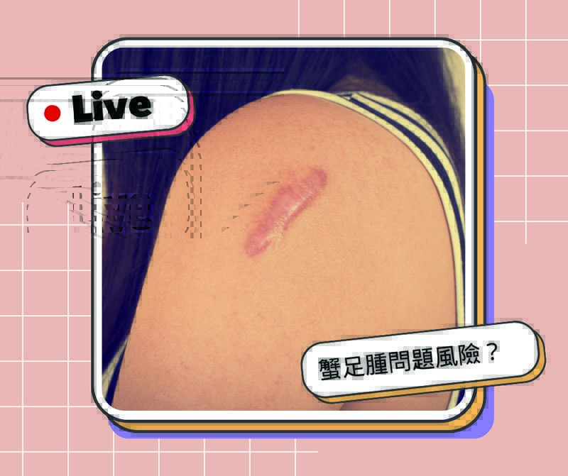 隆乳術後可能面臨5大問題係金A?如何避免位移、水波紋、莢膜孿縮、蟹足腫、二次隆乳一次告訴你! - 第6張圖