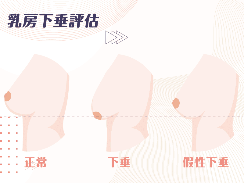 不同胸型的隆乳術式解析 下垂外擴大小奶產後萎縮都有解 - 第2張圖