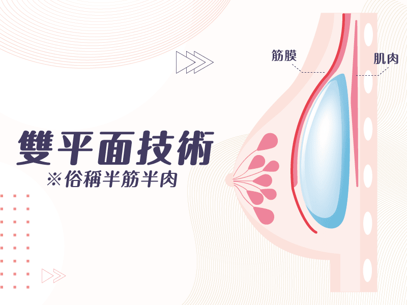 隆乳必5大成功要素!手術方式、切口、擺放位置、術後照護通通告訴你! - 第9張圖