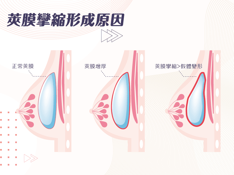 隆乳術後可能面臨5大問題係金A?如何避免位移、水波紋、莢膜孿縮、蟹足腫、二次隆乳一次告訴你! - 第5張圖